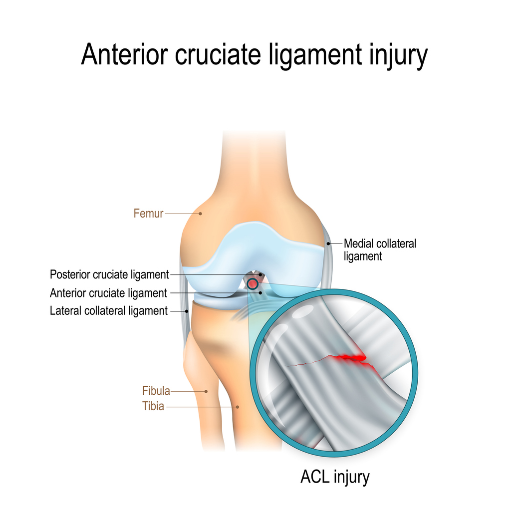 Anterior cruciate ligament injury. joint anatomy. Vector illustration for biological, medical, science and educational use.