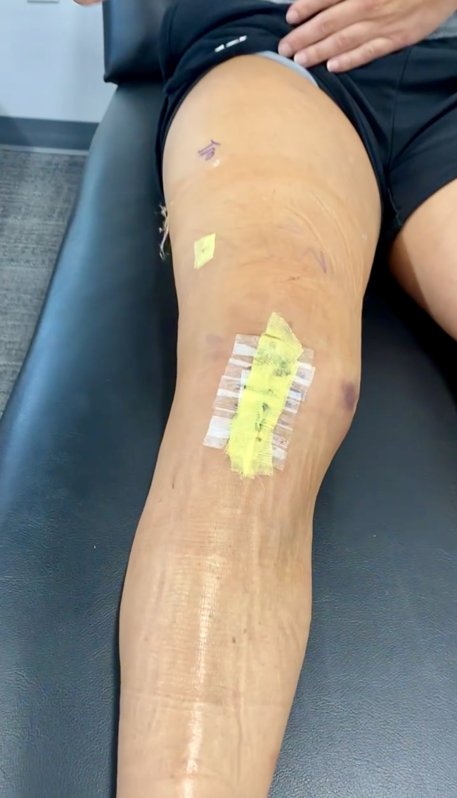 ACL Injury Prevention Training